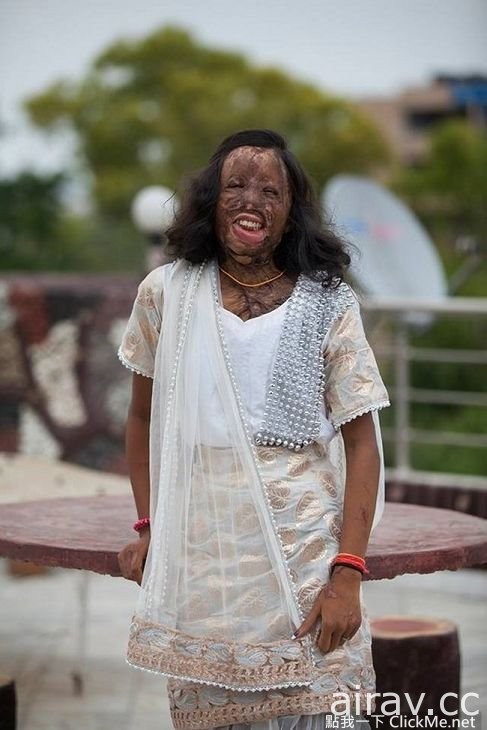 印度女孩血淋淋的寫真：「 硫酸毀了我的容貌，但毀不了我的堅強。」